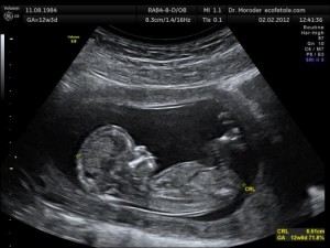 12 week fetus ultrasound