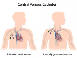 CVC