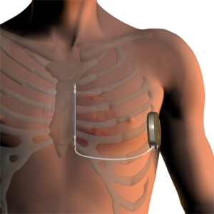 S-ICD