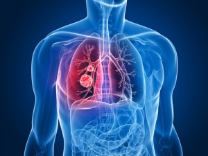 Tumore polmonare