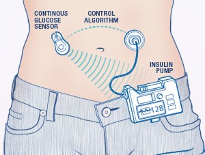 artificial-pancreas-diagram_mayoclinic