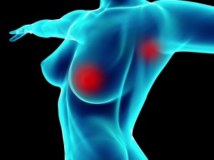 tumore mammario seno