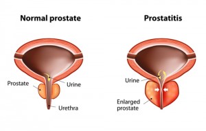 prostata