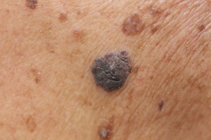 melanoma