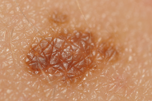 Age Spot or Skin Cancer? | Ag3derm