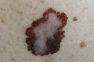 melanoma