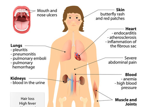 LES, dallo studio ALLEGORY evidenze positive per l’efficacia di obinutuzumab. I dati pubblicati da NEJM