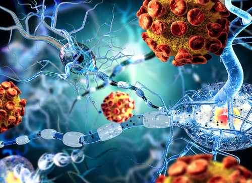 Sclerosi Multipla: l’importanza del dosaggio dei neurofilamenti a catena leggera per anticipare i cambiamenti invisibili