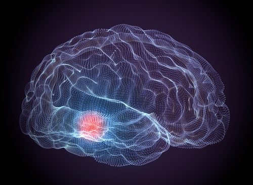 Parkinsonismi atipici. Definito un nuovo algoritmo diagnostico basato su esami neurofisiologici