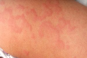 Orticaria Cronica Spontanea, Commissione europea approva remibrutinib