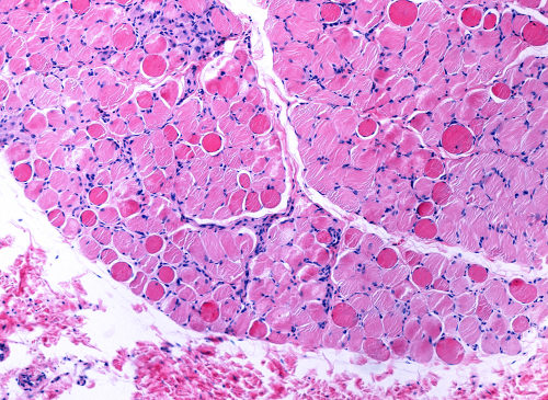 Distrofia Muscolare di Duchenne: vamorolone conferma benefici a lungo termine