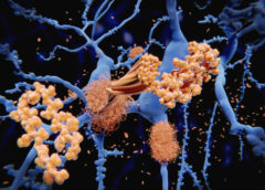 Alzheimer beta amiloide
