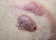 linfoma cutaneo