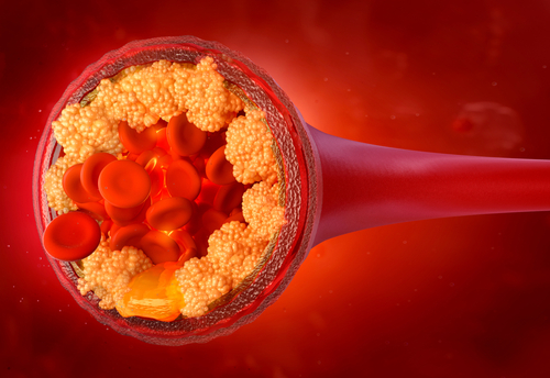 Cardiovascolare, studio V-DIFFERENCE: inclisiran riduce colesterolo e dolori muscolari in tre mesi