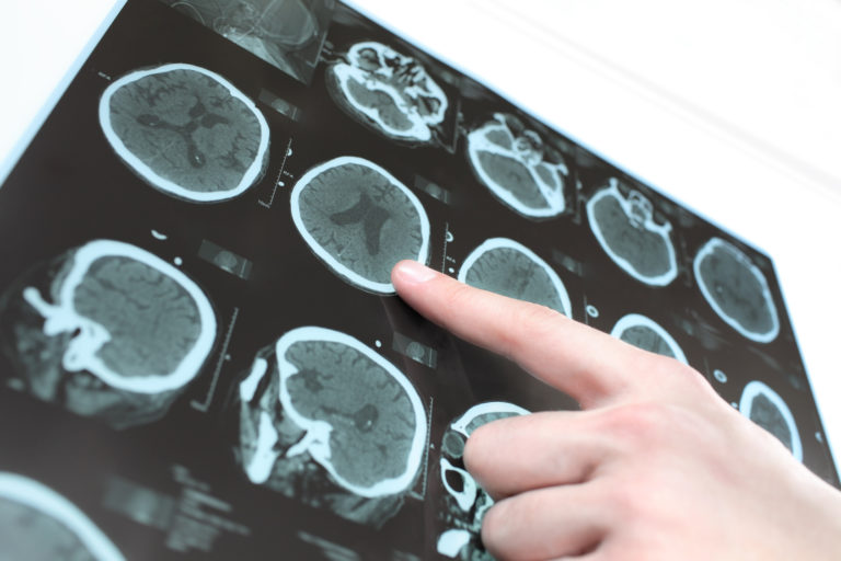 Si Guarisce Dal Tumore Al Cervello