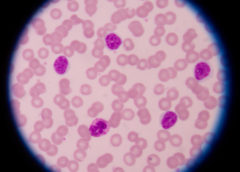 Leucemia Linfatica Cronica: ok AIFA a rimborsabilità acalabrutinib nella nuova formulazione in compresse