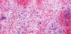 Mielofibrosi: la sfida terapeutica è tenere sotto controllo l’anemia con nuovo JAK inibitore