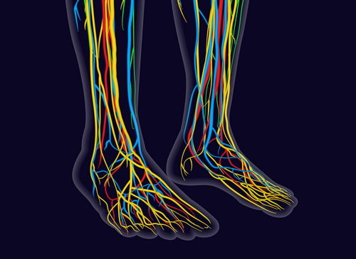 Neuropatia, condizione sottodiagnosticata e molto comune