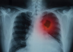 Tumore al polmone in stadio precoce: CE approva pembrolizumab prima e dopo la chirurgia
