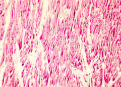 cardiomiopatia ipertrofica