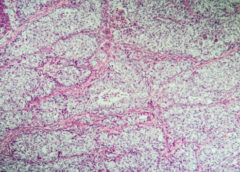 cancro ovarico microscopio