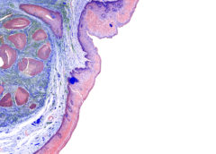 ovarian cancer istologia