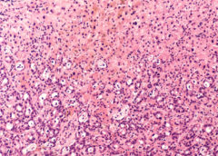 tumore pancreas