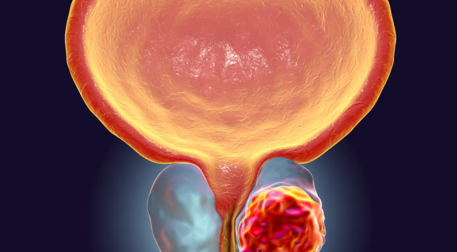 Al via “MEN’S PRO”, campagna di informazione sul tumore della prostata metastatico