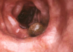 cancro al colon