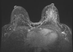 risonanza magnetica seno