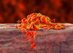 tumore gastrico