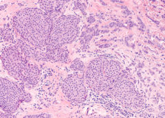 carcinoma lobulare