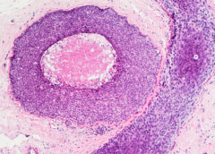 DCIS carcinoma duttale in situ