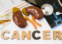 cancro rene