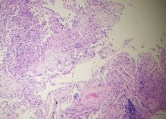 danno alveolare diffuso